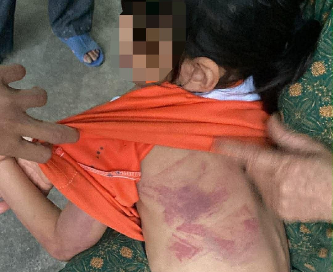 Bé gái lớp 2 bị bạn đánh bầm tím người - Ảnh: NVCC